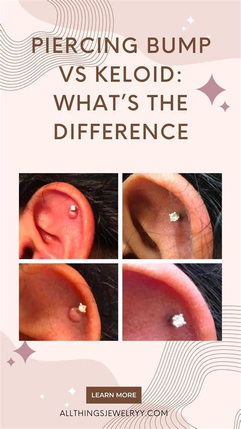 keloid nose piercing|piercing bump vs keloid pictures.